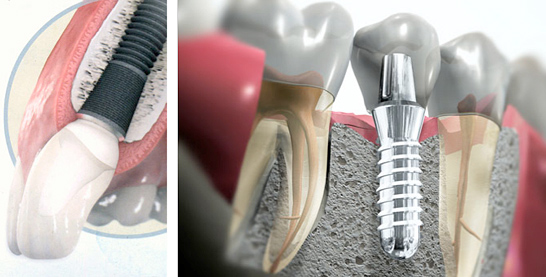 implantes dentales en coslada